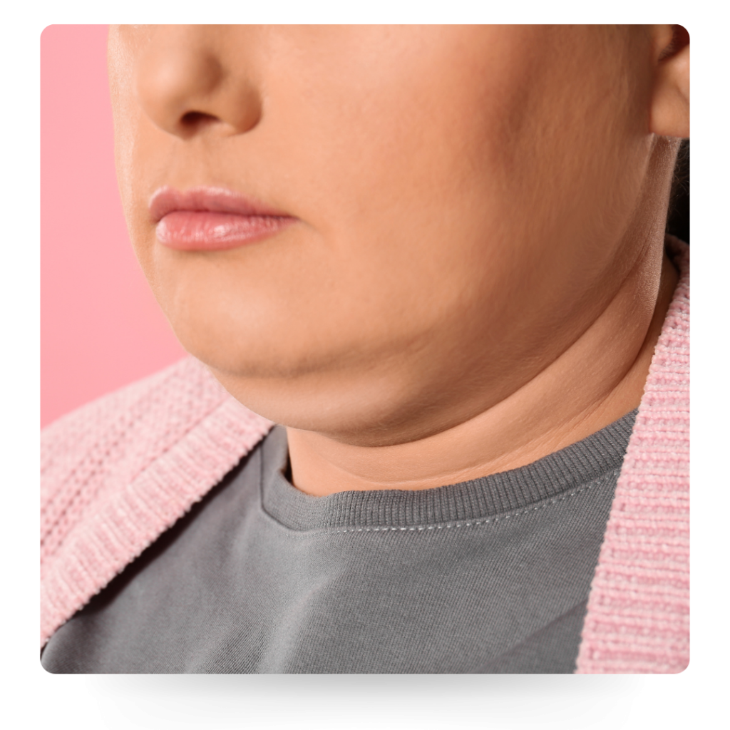 metaponin-double-chin